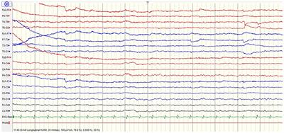First Reported Case of Neuroleptospirosis Complicated With Anton's Syndrome